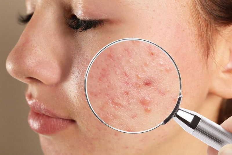 The Microbiome Revolution in Skincare: Why Probiotic Face Washes Are Changing How We Treat Acne